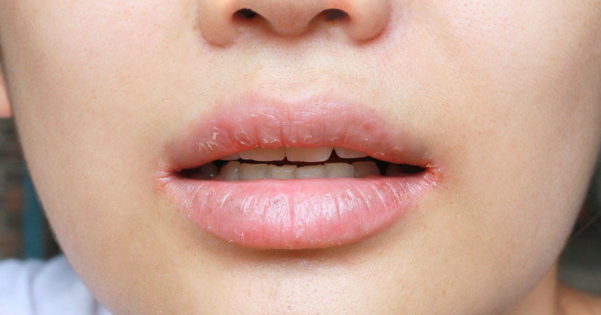 โรคปากนกกระจอก (Angular Cheilitis) อาการ สาเหตุ วิธีรักษา