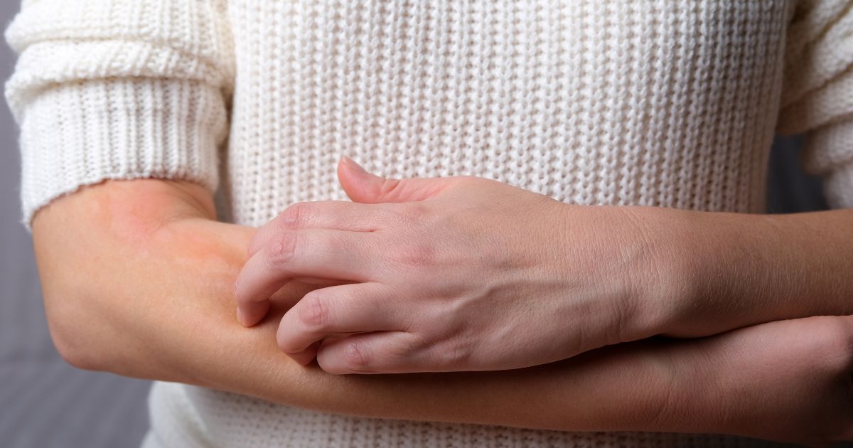 แพ้น้ำ รักษาโรคลมพิษจากการสัมผัสน้ำ - The symptoms of Aquagenic Urticaria 