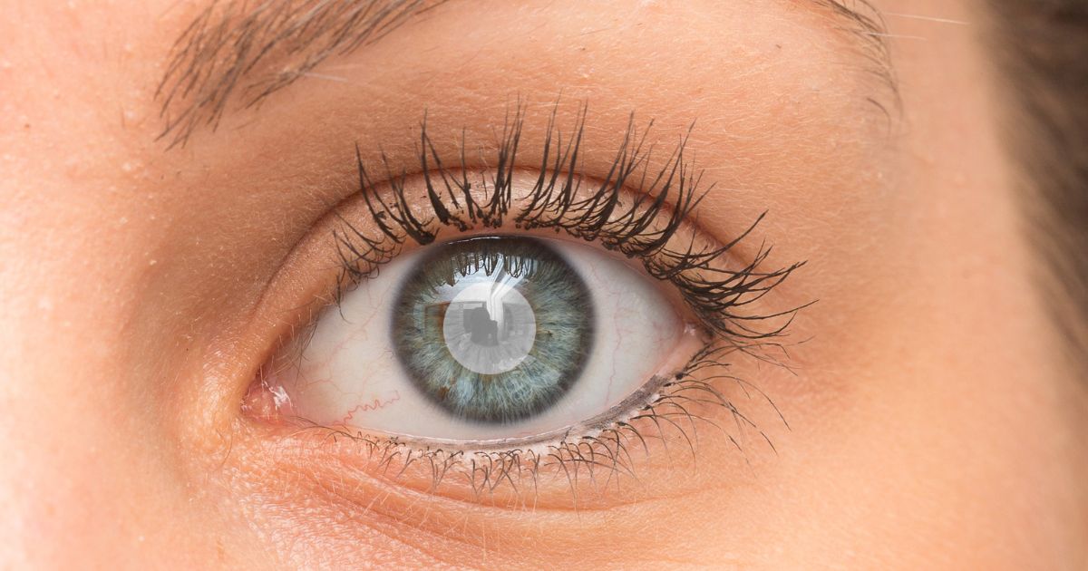 ต้อกระจก (Cataract) เกิดจากอะไร อาการ การรักษา - Cataract: Causes, Symptoms, Treatments, Early signs