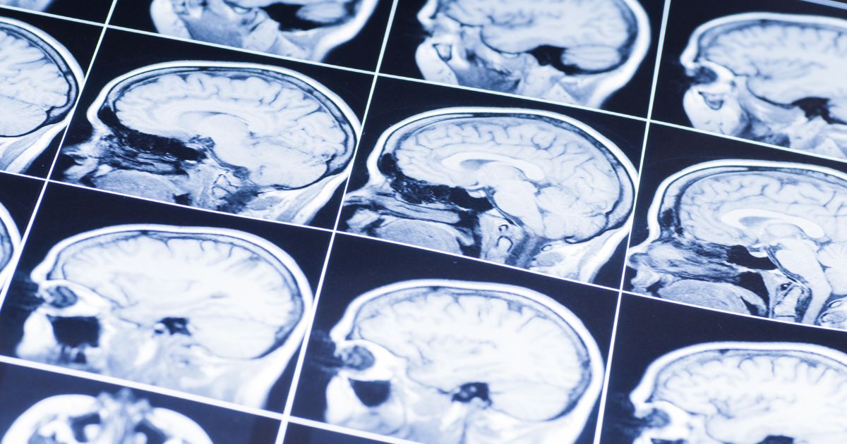 สาเหตุ อาการ วิธีการรักษาเลือดออกในสมอง (Intracerebral hemorrhage/Brain bleeds)