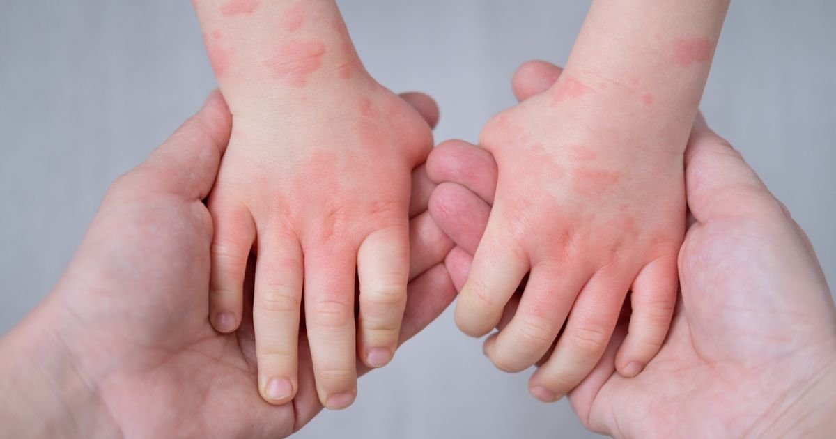 สังเกตสักนิด ถ้าคิดถึงแพ้อาหาร - Understanding food allergy is crucial for your and your child’s safety