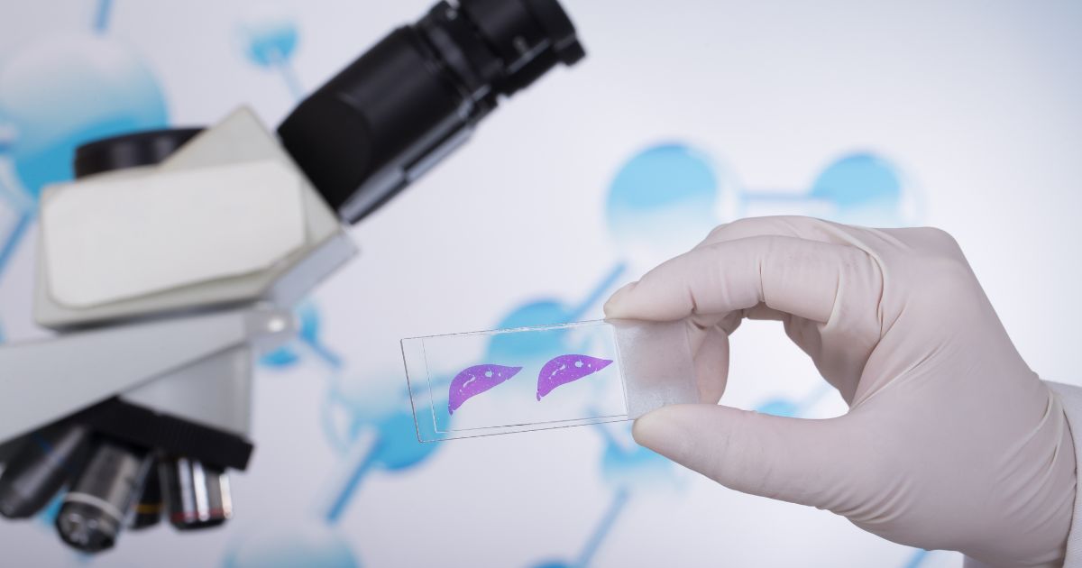 ขั้นตอนและผลตรวจการเจาะชิ้นเนื้อตับ - Liver Biopsy: Procedure, Rusults and After