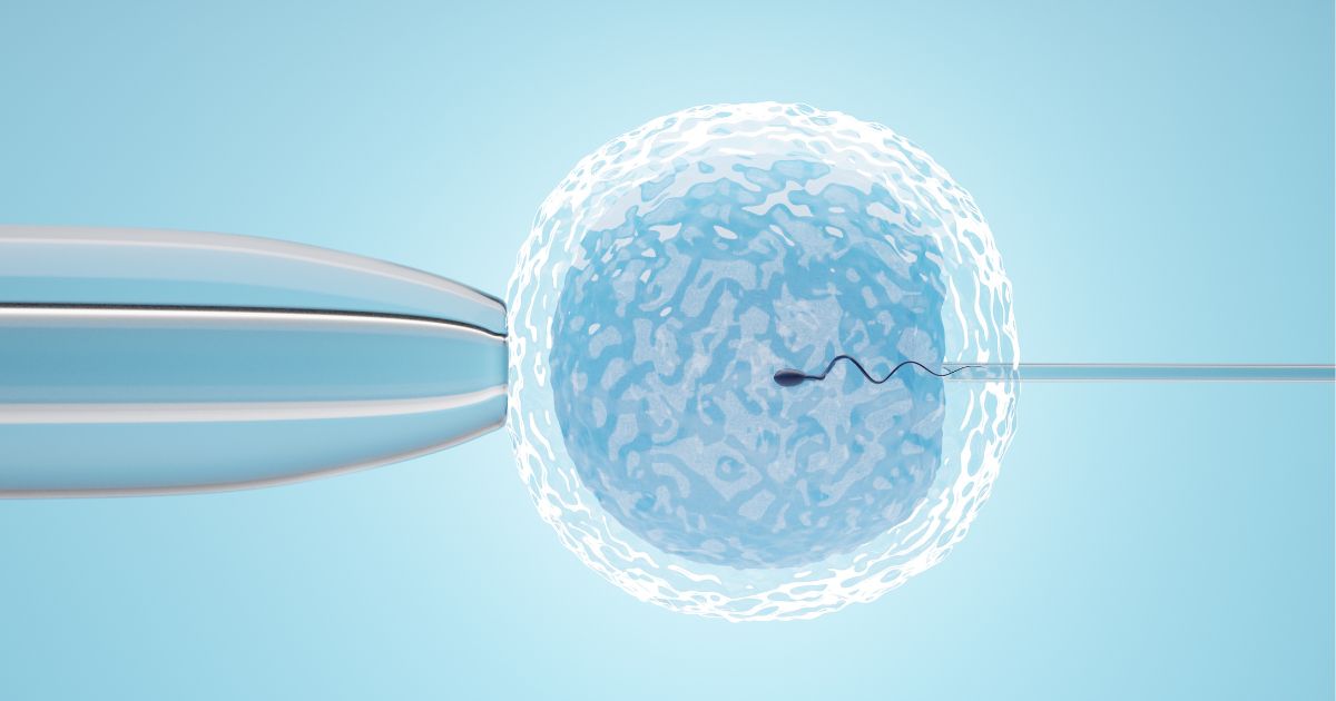 การทำอิ๊กซี่ (ICSI) หรือการฉีดตัวอสุจิเข้าไปในไข่ Intracytoplasmic sperm injection