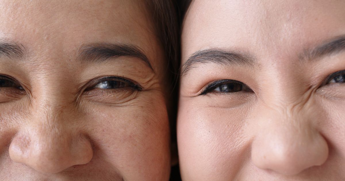 สาเหตุ อาการ การตรวจวินิจฉัยและการรักษาหนังตาตก - Ptosis (Drooping eyelids) Causes, Symptoms, Diagnosis and Treatment