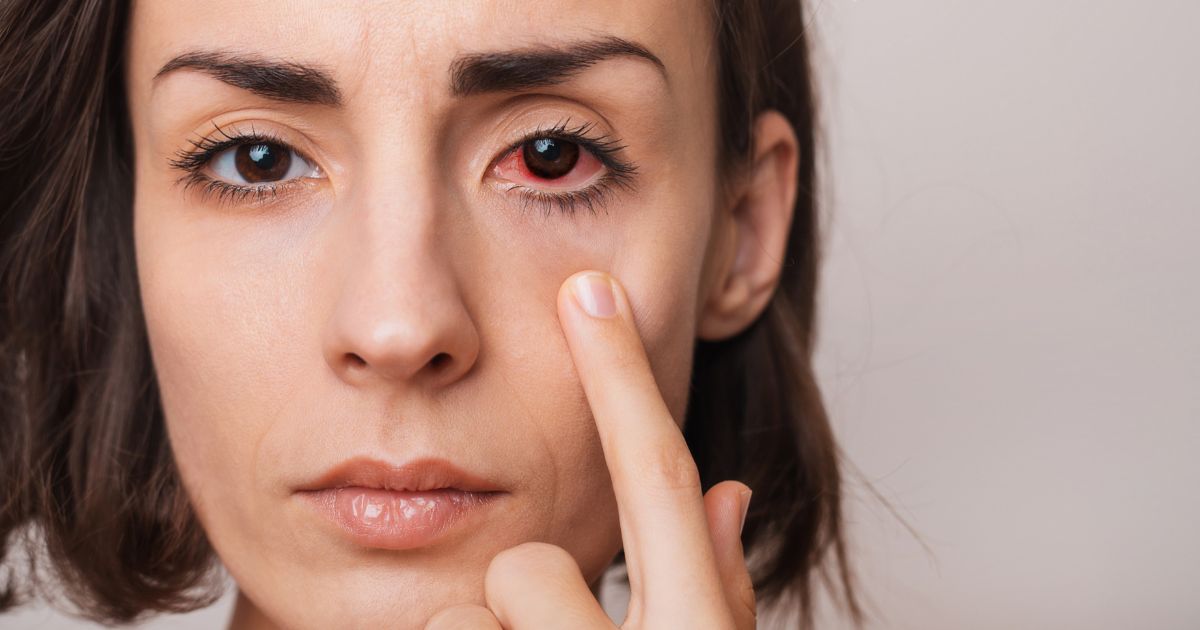 สาเหตุ อาการ วิธีรักษาม่านตาอักเสบ - Causes, Symptoms, Treatment of Uveitis