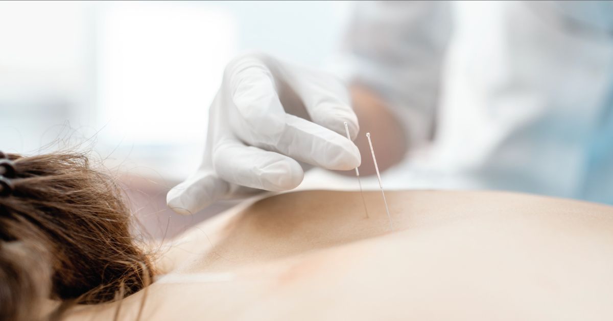 การฝังเข็ม (Acupuncture): ประเภทการฝังเข็ม โรคที่ช่วยได้ และขั้นตอนการรักษา