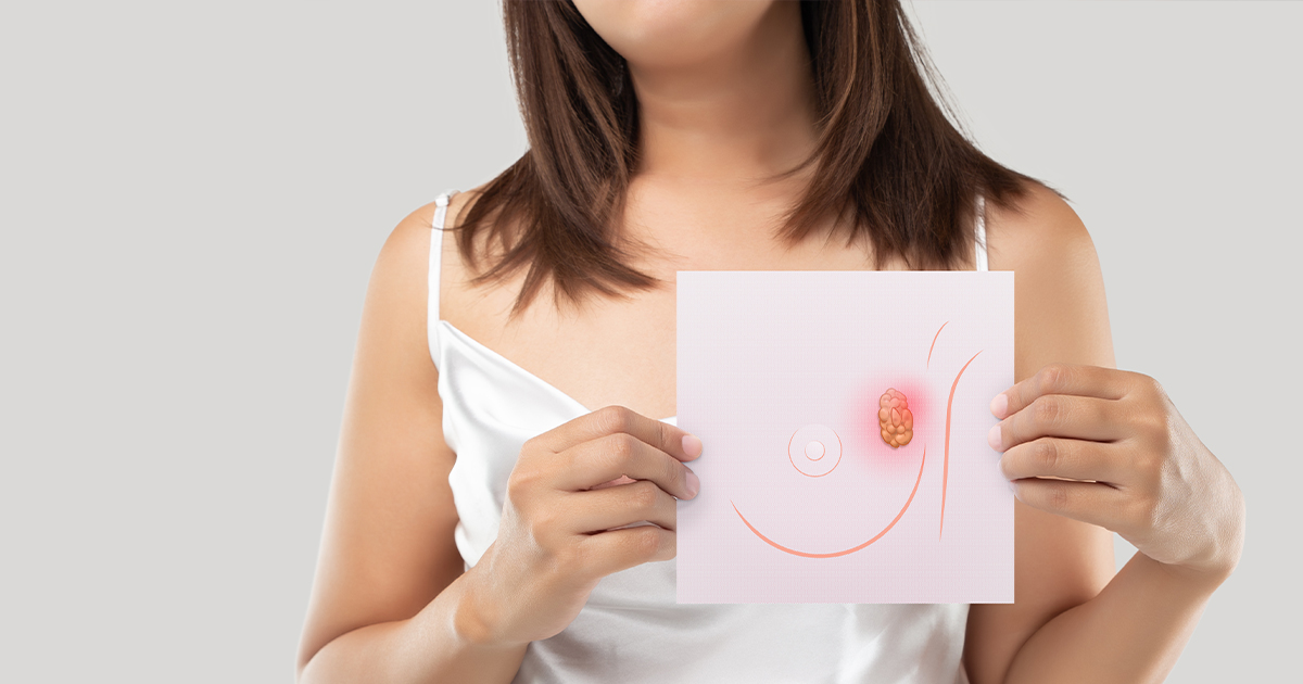 อาการ สาเหตุ และวิธีการรักษามะเร็งเต้านม (Breast Cancer Treatment)