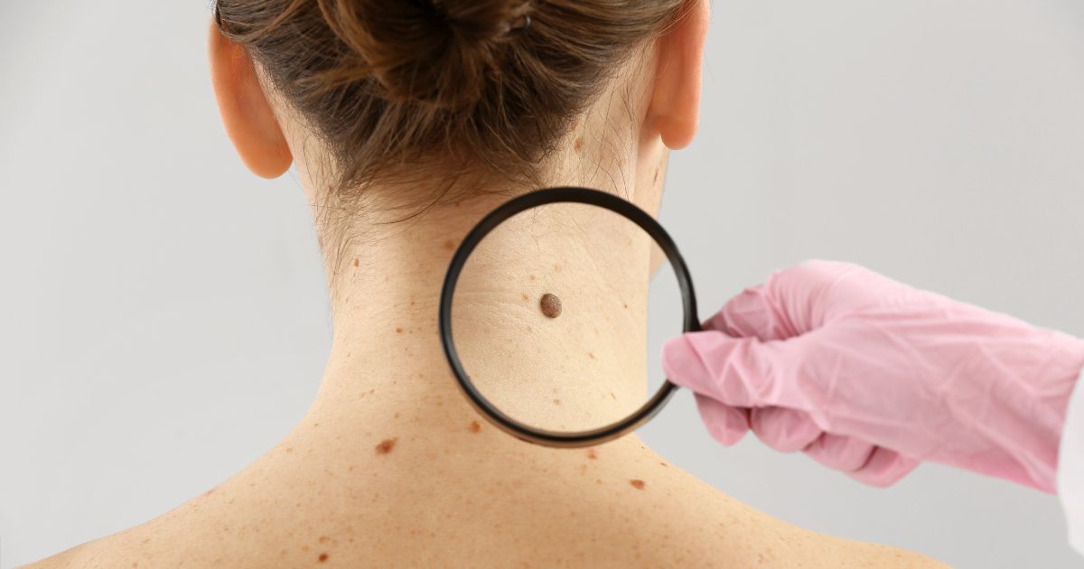 ขั้นตอน การรักษาด้วยวิธีผ่าตัดมะเร็งผิวหนังด้วยวิธีโมหส์ - Mohs Surgery for Skin Cancer, Procedure, Benefits