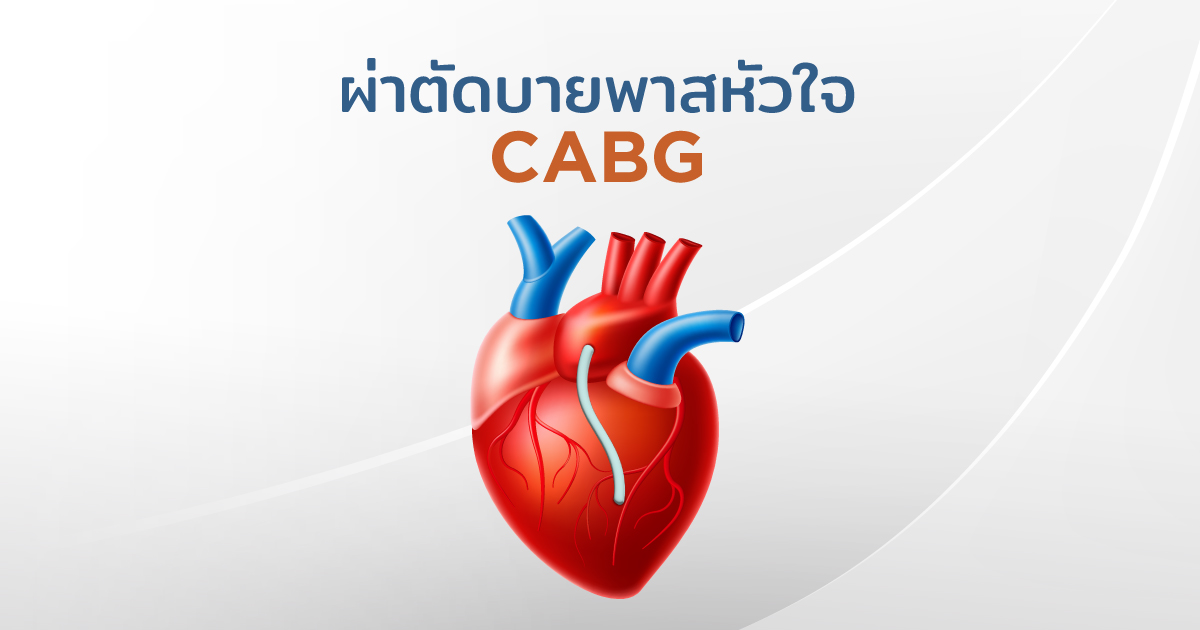 ผ่าตัดบายพาสหัวใจ-Coronary Artery Bypass Grafting (CABG)