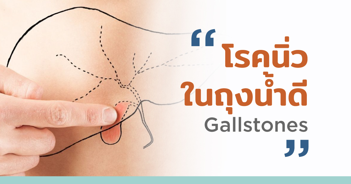 อาการ สาเหตุ การวินิจฉัยและการรักษาโรคนิ่วในถุงน้ำดี - Gallbladder Stones