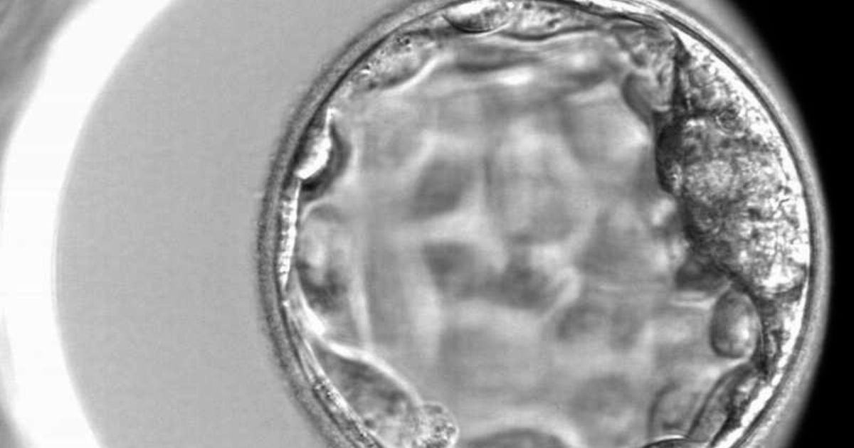 การแบ่งเกรดตัวอ่อน สำหรับทำเด็กหลอดแก้ว - IVF Embryo Grading