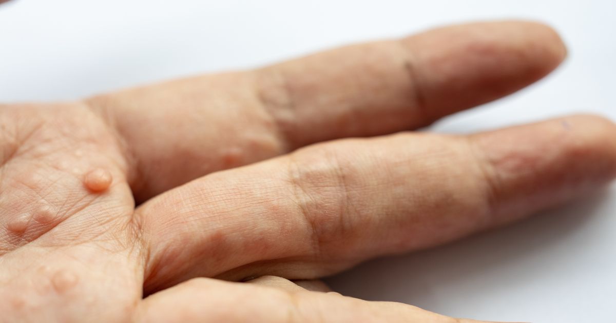 ท้าวแสนปม เกิดจากอะไร อาการ สาเหตุ การรักษา - Neurofibromatosis: Symptoms, Causes and Treatment