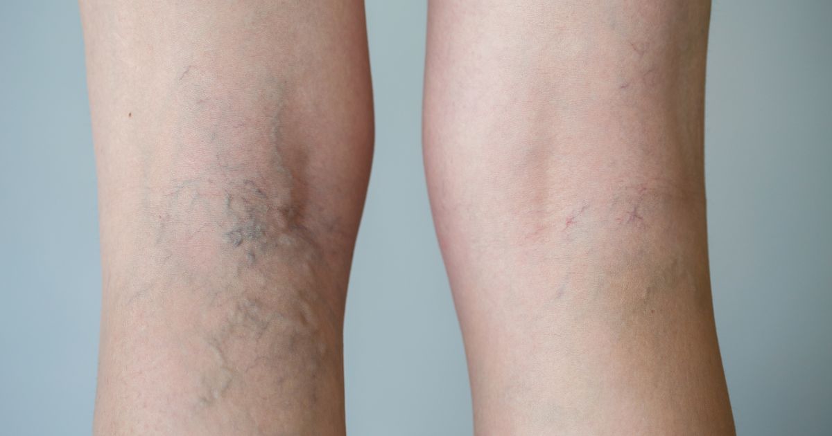 อาการ สาเหตุ การวินิจฉัยและการรักษา ภาวะลิ่มเลือดอุดตัน-Thrombosis Symptoms, Causes, Diagnose, Treatment