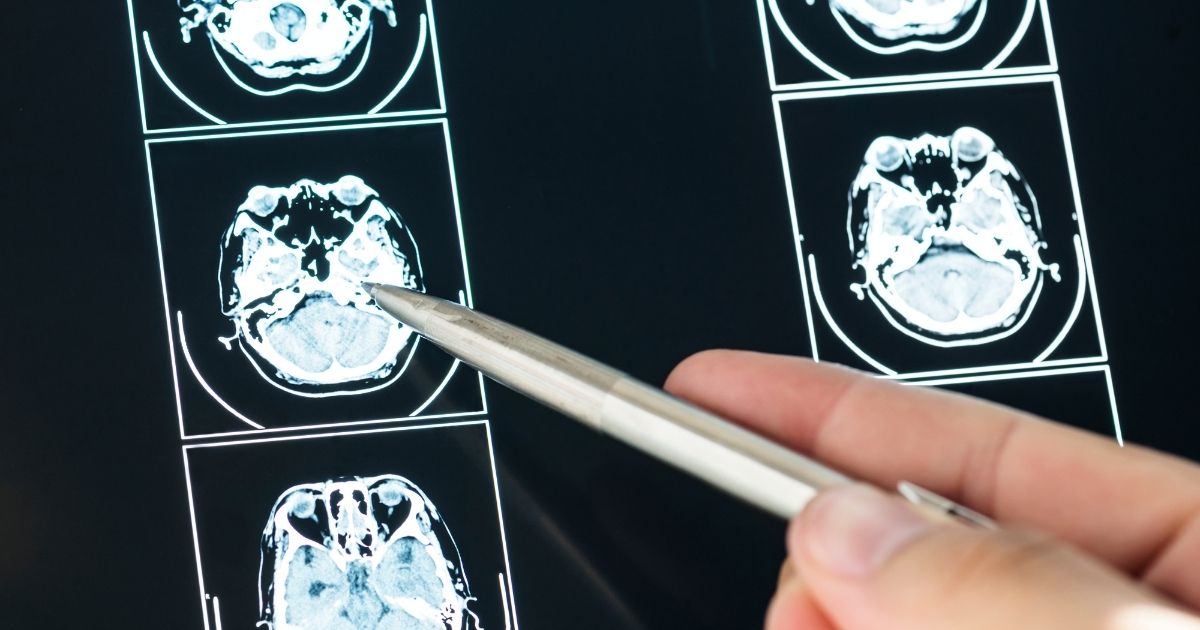 เนื้องอกต่อมใต้สมอง - Pituitary Tumor