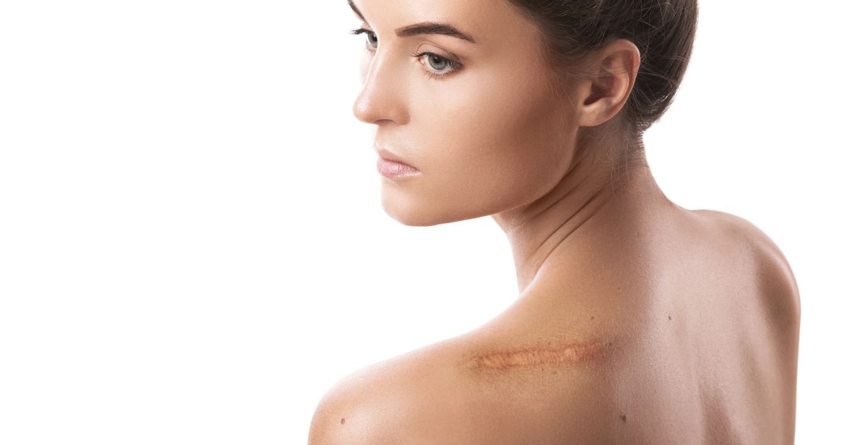 รักษาแผลคีลอยด์ ด้วยการฉายแสง แผลนูนหนา แผลผ่าตัด ผ่าคลอด - Radiation therapy for keloid scars: Keloid scar treatment