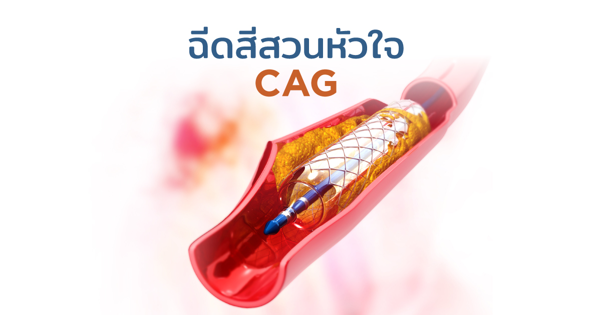 ฉีดสีสวนหัวใจ ตรวจหลอดเลือดหัวใจตีบตัน - Coronary Angiogram: Diagnose CAD