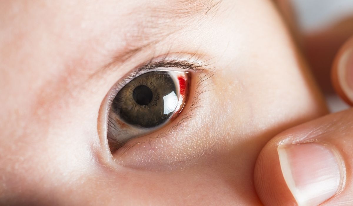 ภาวะเลือดออกใต้เยื่อบุตา เกิดจากอะไร ต้องรักษาอย่างไร - Subconjunctival Hemorrhage - Causes and Treatment
